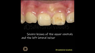 Enamel Hypoplasia Management [upl. by Winterbottom]