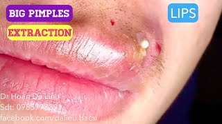 Mụn bọc môi toDermatologistpimples whitehead blackheadanti acnesevere pustule removal [upl. by Atinev]