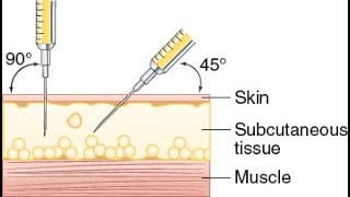 Subcutaneous Injection Demonstration [upl. by Aran995]