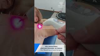 PO FRATURA proximal de úmero  Laserterapia e Dry Needling [upl. by Sokil]