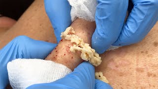 Stubborn Sac and Cyst Removal  CONTOUR DERMATOLOGY [upl. by Favin]