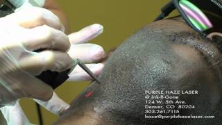 Dark Skin Laser Hair Removal [upl. by Dabbs]