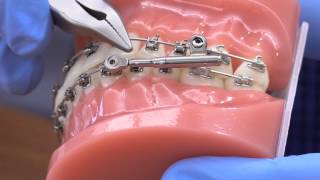 American Orthodontics PowerScope Activation [upl. by Aralc562]