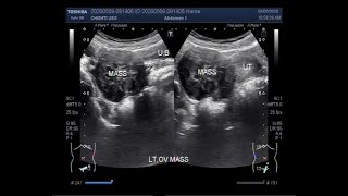 Ultrasound Video showing an Ovarian tumor [upl. by Joses894]