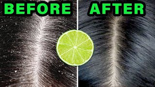 How to REMOVE DANDRUFF in 10 minutes USING LEMON JUICE [upl. by Philemol]