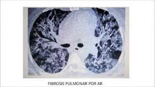 Fisiopatología de la Artritis Reumatoide  Dr Barrantes [upl. by Itirp]