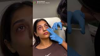 Dermis Clinic  Dark Circles pigmention darkeyes skincareroutine skincare manchester [upl. by Leamsi]