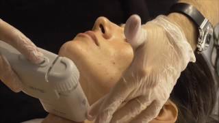 HIFU Facial  Demostración Ultralift HIFU  Cosmobeauty2017 [upl. by Eul]