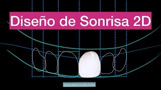 Tutorial 4 diseño de sonrisa básico Encerado virtual [upl. by Midan]