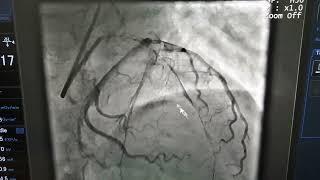 Cath lab complications Air Embolism amp No reflow Pci to Lad with severe Lv dysfunction [upl. by Attela]