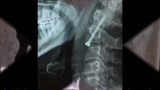 Odontoid Screw Fixation  HIMS Dehradun [upl. by Aronos]