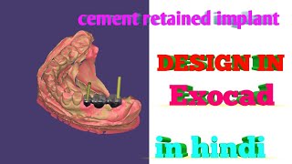 How to design implant DMLS in exocad Implant DMLS cement retained implant bridge dentalimplant [upl. by Ahsieka]