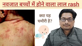 नवजात बच्चों में होने वाला लाल rash  Erythema Toxicum Neonatorum rashes neonatalcare infant [upl. by Whipple31]