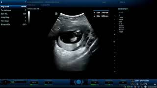 bicornuate gravid uterus 12wks pregnant woman Diagnostic ultrasound cases [upl. by Naujled]