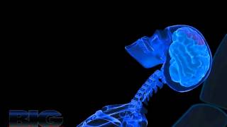 Whiplash Injury Animation Adobe Flash HD [upl. by Eirlav]