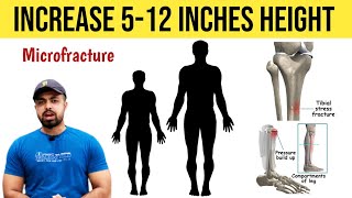 How To Increase Height With Microfracture 512 Inches  Best Exercises [upl. by Cutty]