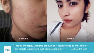 PRAVENTAC™ Acne Pills Review 4  Results  Customer Before amp After [upl. by Trygve]