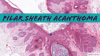 Pilar Sheath Acanthoma vs dilated pore of Winer 5Minute Pathology Pearls [upl. by Nickolaus477]