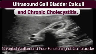 Ultrasound Gall bladder Chronic Cholecystitis and Calculi [upl. by Belcher750]