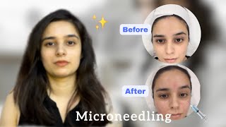 My first professional microneedling treatment  Before and After  1 week results✨ [upl. by Munroe]