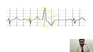 Mastering ECGLesson17 PVCs amp PACs  premature ventricular amp atrial contractions [upl. by Tirza59]