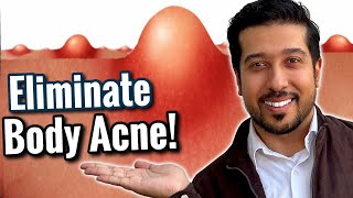 How to CLEAR Back Acne Chest Acne and Folliculitis  RID Body Acne [upl. by Mcgee452]