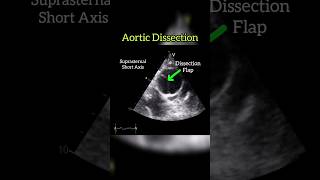 Aortic Dissection Type A echocardiography cardiology anatomy heart shorts [upl. by Jeana409]