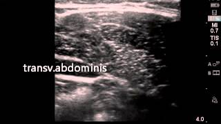 Ultrasound guided transversalis fascia plane block [upl. by Dayna]