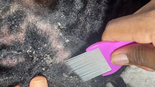 ASMR Extreme Flakes Removal asmrdandruff asmr asmrscalpcheck [upl. by Januarius275]