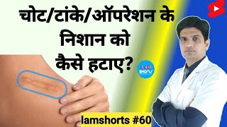 चोटटांकेऑपरेशन के निशान को कैसे हटाए Shorts lamshorts [upl. by Dayir454]