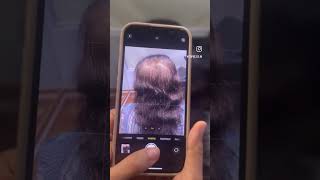 Hair loss solution Human hair toppers for women in Bangalore Hair thinning treatment  Hair patch [upl. by Eelam]