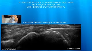 Ultrasound Guided Subdeltoid Bursa Glenohumeral injection in a Female with Rotator Cuff Arthropathy [upl. by Russia]