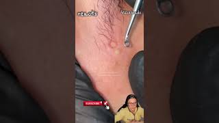 blackheads nose blackheads removal satisfying blackheads removal lips blackheads removal ear [upl. by Sahpec]