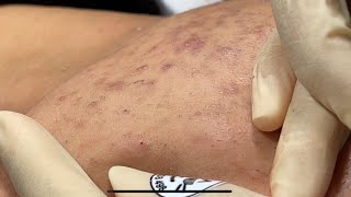 Blackheadsamp Whiteheads Removal On Boy Chin 2024  Acne Treatment Bo Nguyễn Spa [upl. by Tess983]