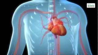 Angioplasty Procedure Animation Video [upl. by Nylacaj]