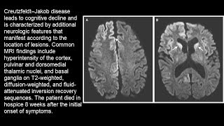 Creutzfeldt–Jakob Erkrankung [upl. by Nnateragram]