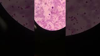 High platelet count platelets clumps  mega platelets  blood smear  mltwithmasood9010 [upl. by Trip]