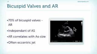 Causes of Aortic Regurgitation [upl. by Muhammad]