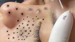 Big Cystic Acne Blackheads Extraction Blackheads amp Milia Whiteheads Removal Pimple Popping  8137 [upl. by Skippy]