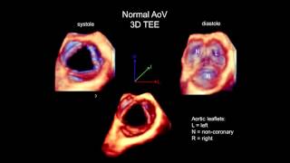 3D Echocardiography Acquisition Cropping and Case Examples [upl. by Aniaj928]