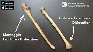 Monteggia and Galeazzi FractureDislocation  Orthopedics  TCML [upl. by Rufford573]