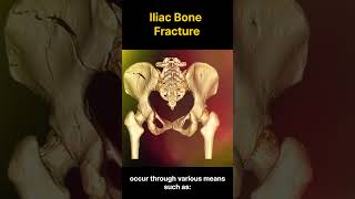 Pelvic Injury Navigating Recovery from an Iliac Bone Fracture 골반 부상 장골 골절에서의 회복 가이드 [upl. by Nivrad]