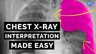 Chest Xray Interpretation  How to Read a CXR  OSCE Guide  UKMLA  CPSA [upl. by Dnalyk]