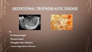 Gestational Trophoblastic Disease  Video SeriesEpi1 [upl. by Suiravaj]