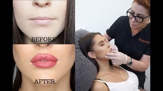 Lip Injections Vlog  My Experience [upl. by Ahsemot]