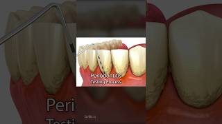 Periodontitis and Laser Hardening Surgery 3D Animation [upl. by Marylee]