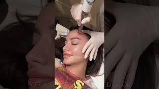 Vector Eye Lift  A revolutionary eye amp brow lifting technique by Fotona dubai fotona facelift [upl. by Sirtimid]