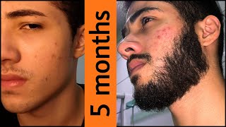 Minoxidil Beard Journey 5 MONTHS TRANSFORMATION [upl. by Hilly128]