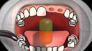 Dental Alveolitis [upl. by Seltzer]