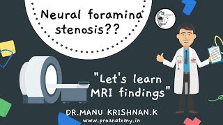 What is quotNeural Foramina StenosisNeural foramina narrowingquot amp spinal nerve root compression [upl. by Krystle682]